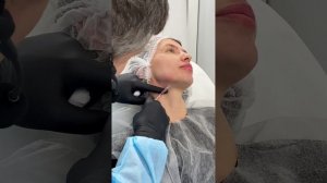 Коррекция ботулотоксином нижней трети лица. Тяжи шеи,