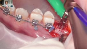 Разбор операции: закрытый синус-лифтинг по методике Fug