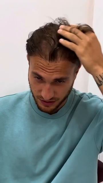 Пересадка волос отличный результат #пересадкаволос