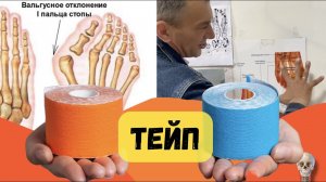 Тейпирование. Плоскостопие. Вальгус