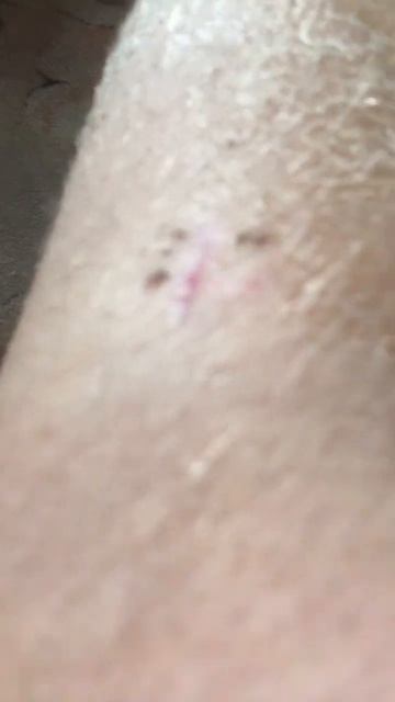 Сняли Гипс ура￼🥳🥳 #funny #shorts #￼подпишись смотреть онлайн