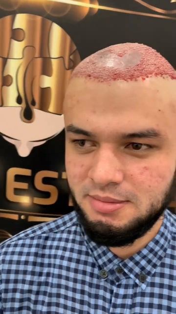 Пересадка волос в Москве #fue #трансплантацияволос #short смотреть онлайн