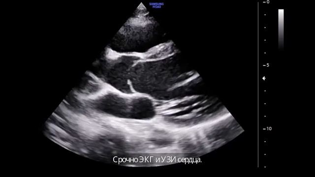 Почему болит сердце? 10 самых распространенных причин. смотреть онлайн