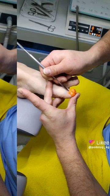 СКОБА ФРЕЗЕРА #скобафрезера #вросшийноготь #подологби смотреть онлайн