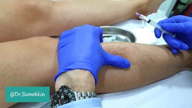 Склеротерапия#1 смотреть онлайн