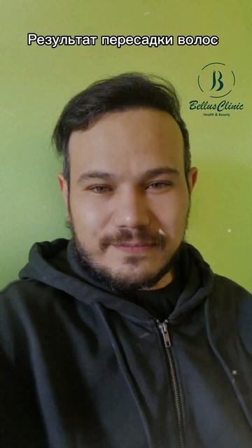 Результат пересадки волос на облысение VII стадии по шк