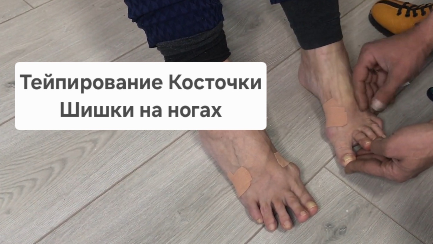 Фиксация ноги в обуви. Тейпирование, шнуровка. Плоскостопие, Косточка, Шишки на ногах смотреть онлайн