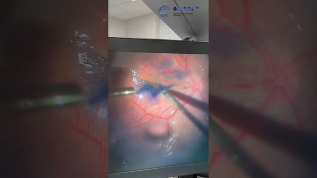 Эпиретинальный фиброз. Лечение. Результат. смотреть онлайн