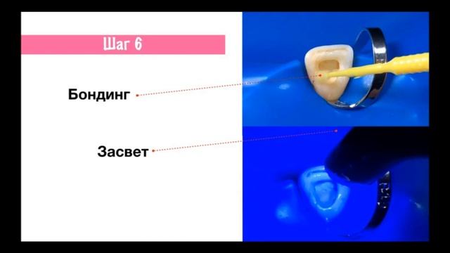 7 Кырманов Внутрикоронковое отбеливание смотреть онлайн