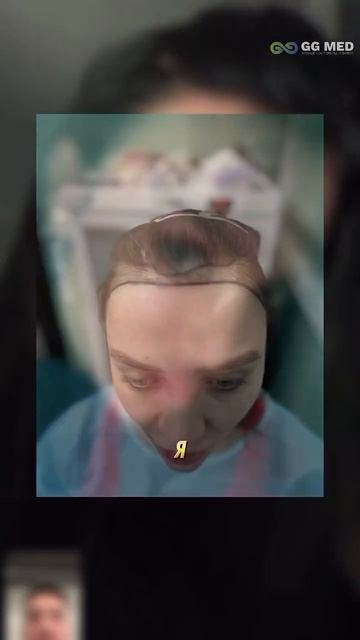 Результат пересадки волос для девушки #пересадкаволо?