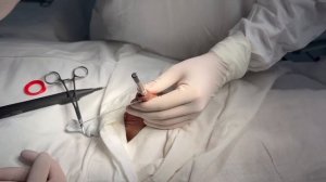 Аппаратное обрезание, циркумцизио. Сircumcision.