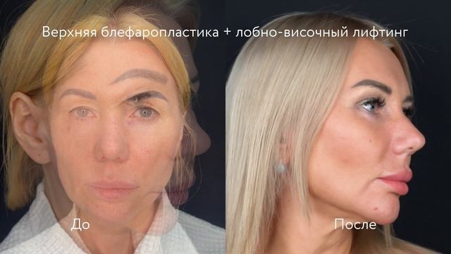 Пластика верхних век и височный лифтинг: молодость в з смотреть онлайн