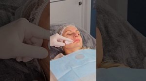 Коррекция филлерами межбровной морщины, носогубных с?
