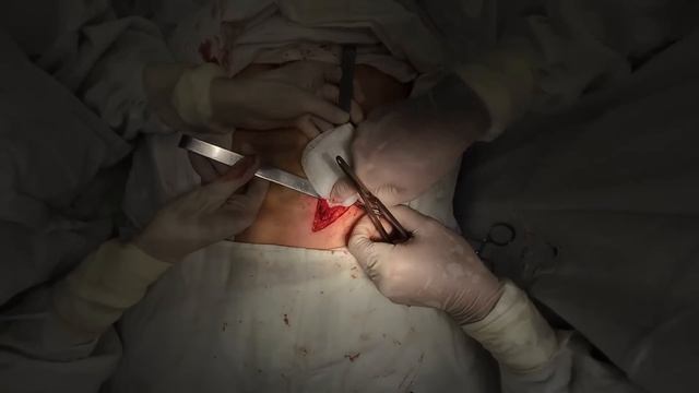 Паховая грыжа   Боль после операции