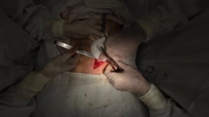 Паховая грыжа   Боль после операции