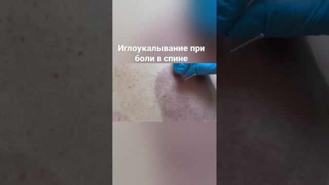 Боль в спине и иглоукалывание. back pain needling