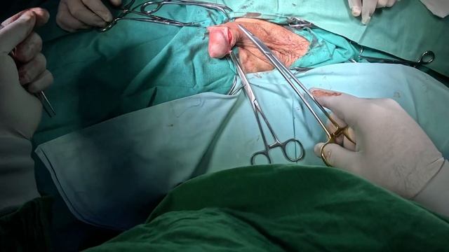 Обрезание крайней плоти. Циркумцизия. Без видеомонтаж