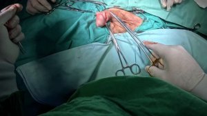 Обрезание крайней плоти. Циркумцизия. Без видеомонтаж