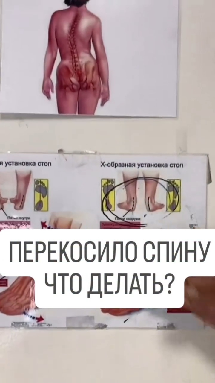 Как избавиться от последствий плоскостопия , перекос спины, таза, коленей, кривых ног #плоскостопие смотреть онлайн