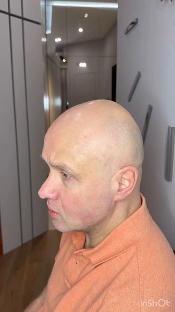 Все женщины его! Встретил клиента на Арбате. Делали трихо 3 мес назад. Scalp Micropigmentation