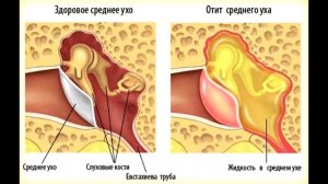 БЕЗ ШАПКИ ЗИМОЙ - ПОСЛЕДСТВИЯ!