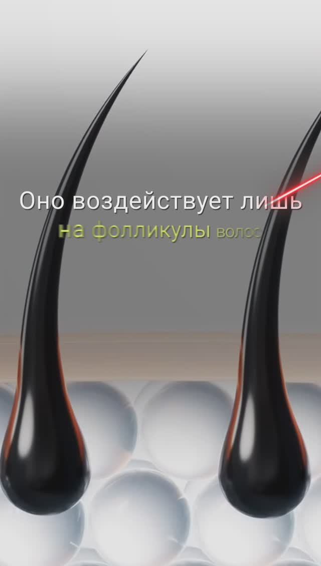 ЛАЗЕРНАЯ ЭПИЛЯЦИЯ ВЫЗЫВАЕТ РАК КОЖИ I ВРЕД ЛАЗЕРНОЙ ЭПИЛЯЦИИ смотреть онлайн