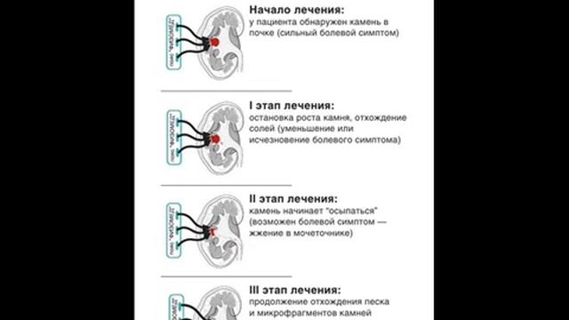 Врач_Ильина_Н_В_：_Как_безопавно_избавиться_от_камней_в_п смотреть онлайн