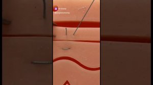 П-образный шов|SurgeON #медицина #тренажер # шов #ССХ #хирур