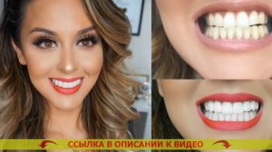 Виниры на зубы установка ❕ Как правильно одевать вини