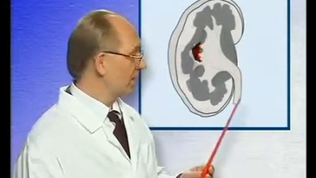 Удаление_камней_в_почках_без_операции_и_дробления_Поя смотреть онлайн