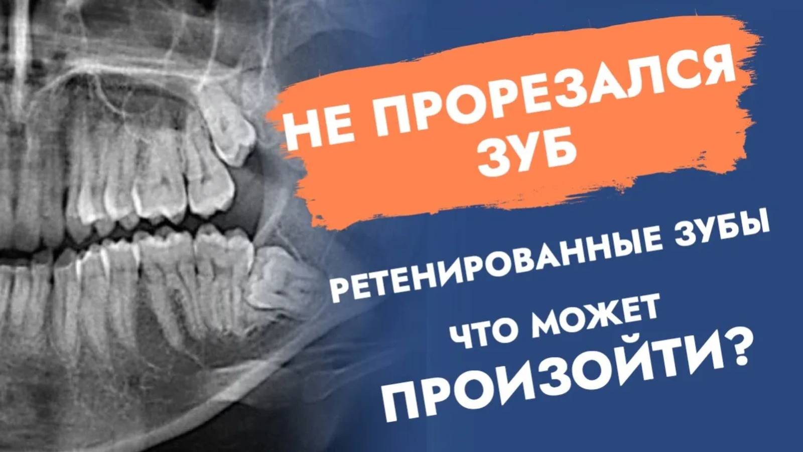 Зуб есть, но не прорезался. Ретенция. Как быть?