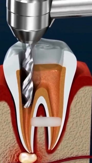 Лечение корневых каналов