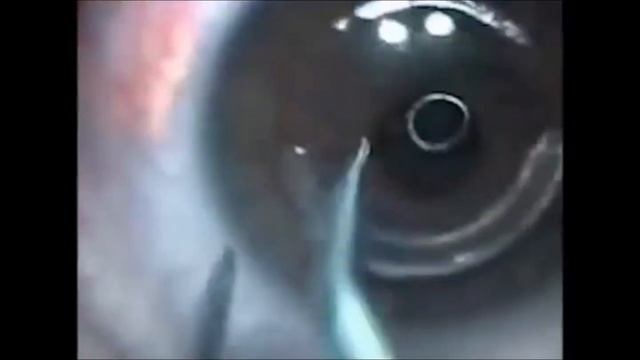 Установка роговичных сегментов (колец) с фемтосопровождением при кератоконусе