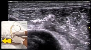 БЛОКАДА ЛУЧЕВОГО НЕРВА #узи #anatomy #ultrasound #anaesthesiology #anaesthes