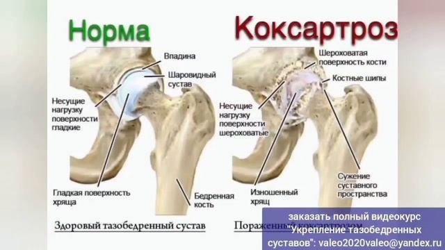 Упал с велосипеда, потом со стула... Как спасти тазобед? смотреть онлайн