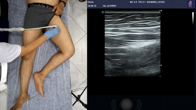 УЗИ Глубоких Вен Нижней Конечности с демонстрацией да смотреть онлайн
