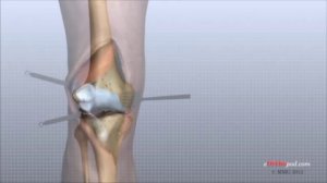 Эндопротезирование коленного сустава НАГЛЯДНЫЙ ОБЗОР