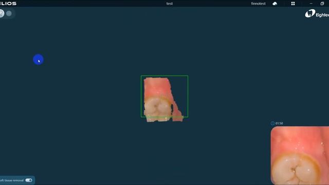 New function Helios 600 software — AI soft tissue removal смотреть онлайн