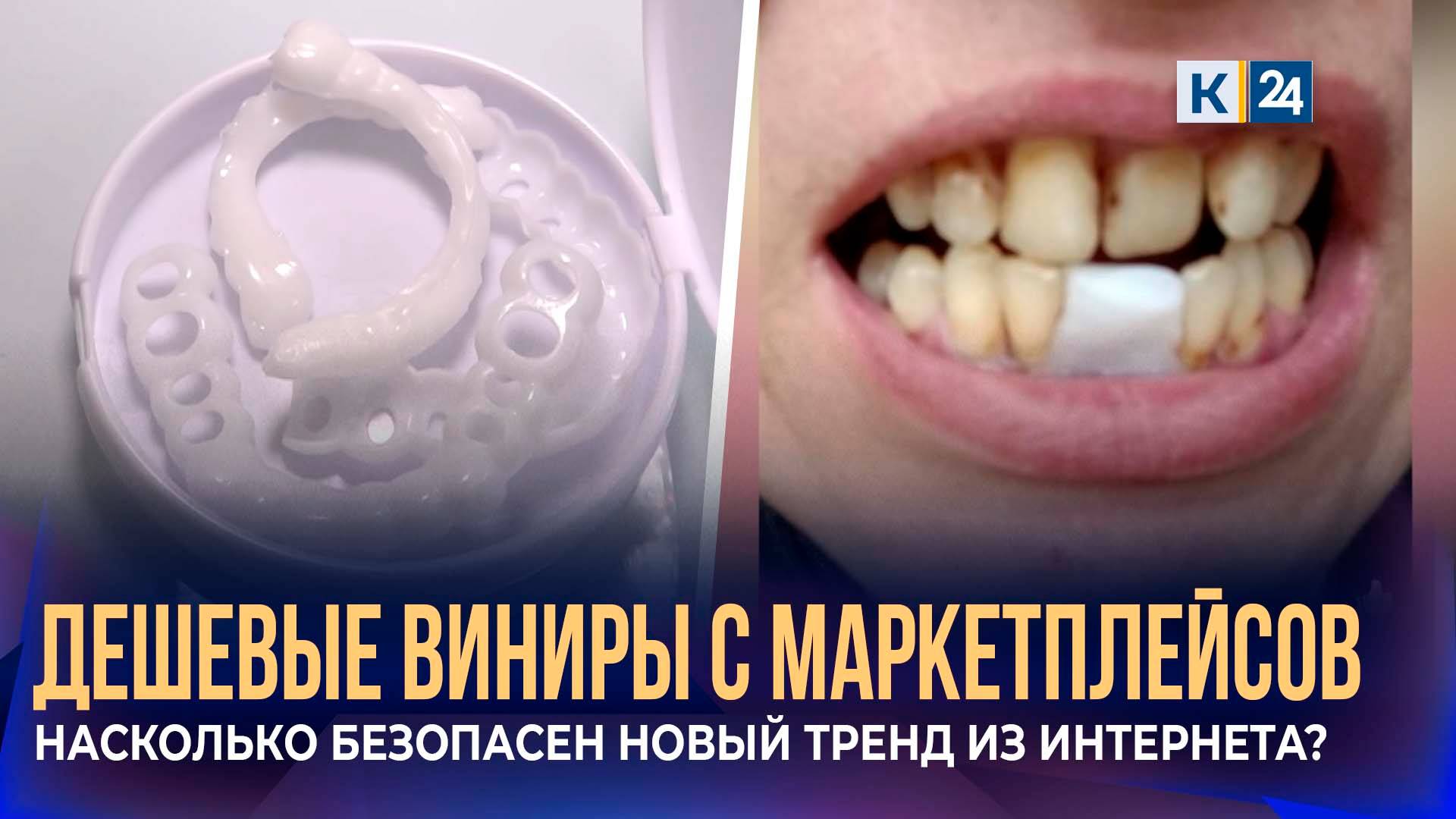 Дешевые домашние виниры с маркетплейсов вызывают опасения стоматологов Кубани смотреть онлайн
