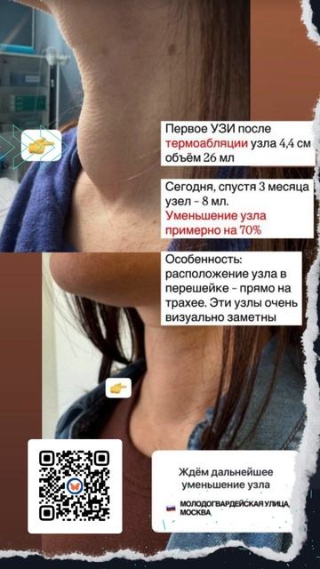 Узел 4,4 см — минус 70% за 3 месяца!
Как? Термоабляция — без операции, без наркоза, за один день!