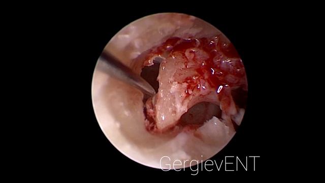 Endoscopic tympanosclerosis surgery / TEES- Тимпаносклероз под контролем смотреть онлайн