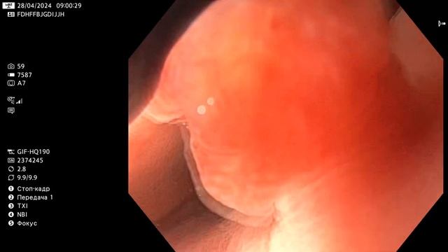 Полипы фундальных желез в желудке. Дисплазия? Гастрос? смотреть онлайн