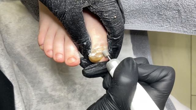 Olga Chistikova .Работа с онихогрифозом. Девочка 8 лет.