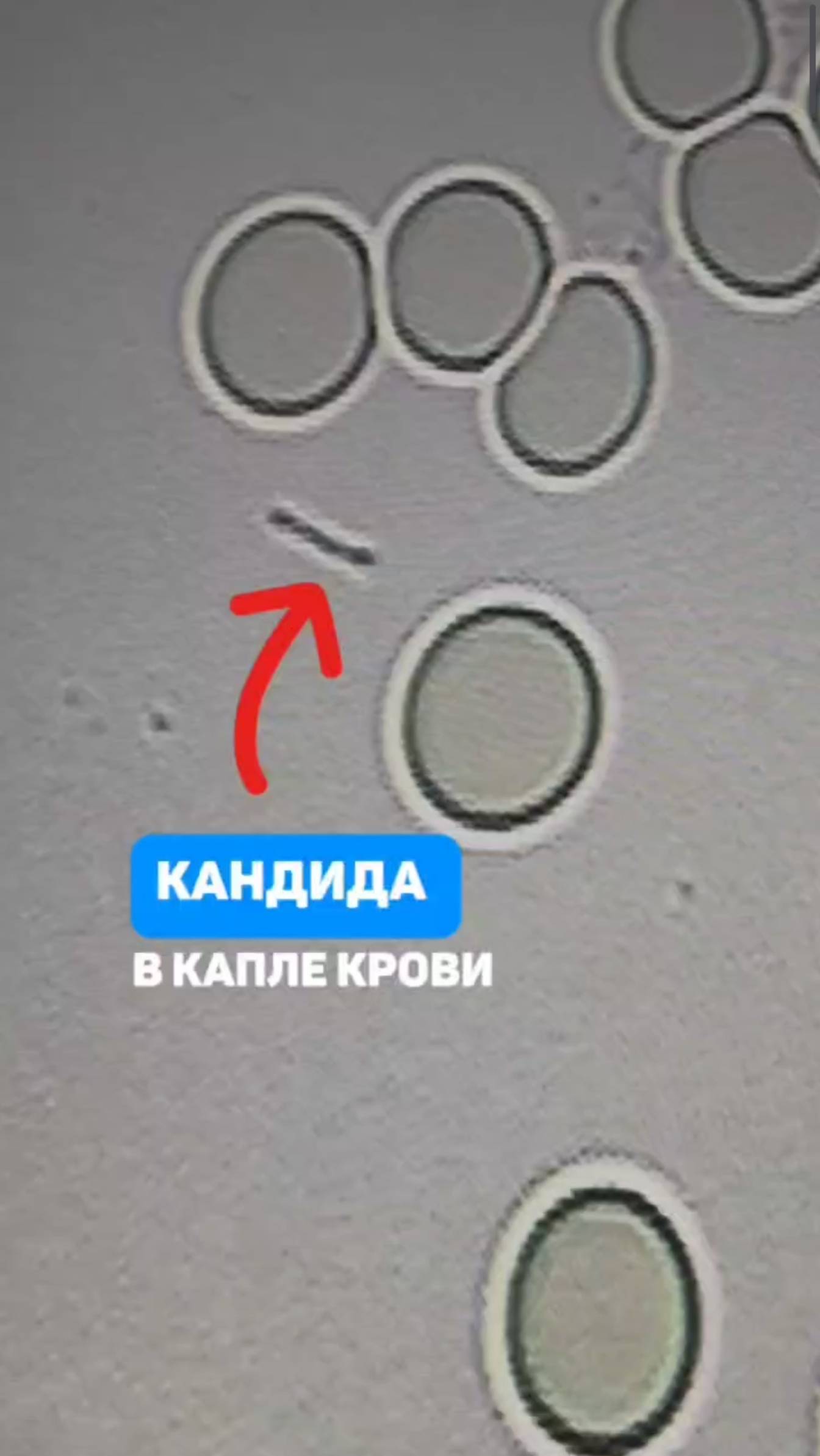 Кандида в крови. В чем опасность и как избавиться? Алена Братишко смотреть онлайн