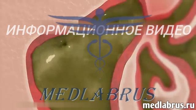 Хирургия синусита. Эндоскопическая хирургия околоносовых пазух