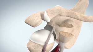 Операция Латарже на плечевом суставе