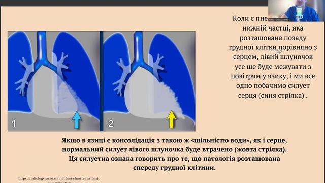 РЕНТГЕН ГРУДНОЇ КЛІТИНИ ЗА 40 ХВ! АНАТОМІЯ ЛЕГЕНЬ. фЛЮР смотреть онлайн