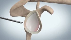 Операция Банкарта при повреждении плечевого сустава -