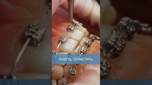 Какую пищу НЕЛЬЗЯ ЕСТЬ в брекетах? смотреть онлайн