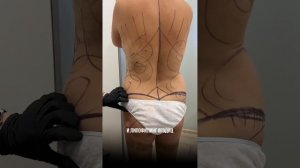 липосакция живота, спины, абдоминопластика, иссечение